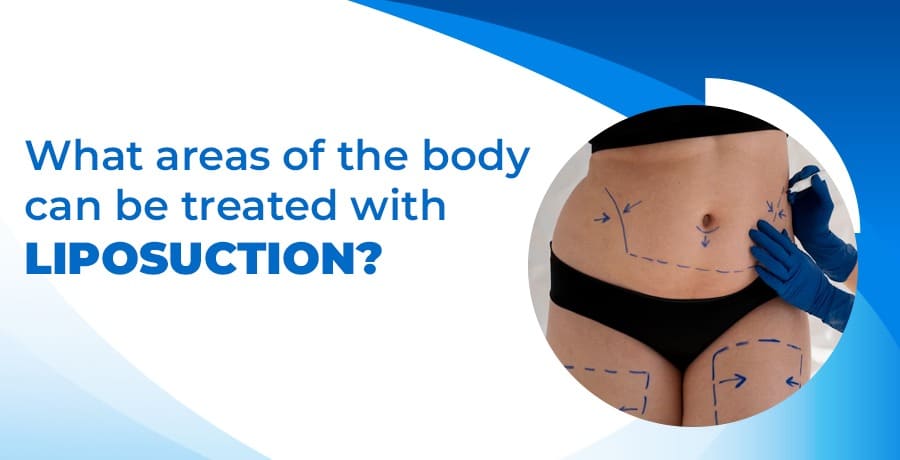 areas-of-the-body-treated-with-liposuction